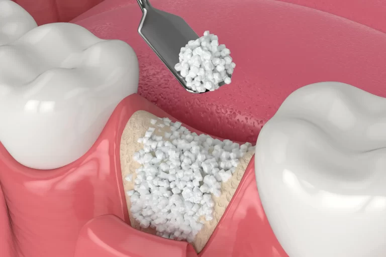 Bone & Sinus Grafting