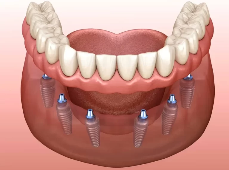 Implant Dentures