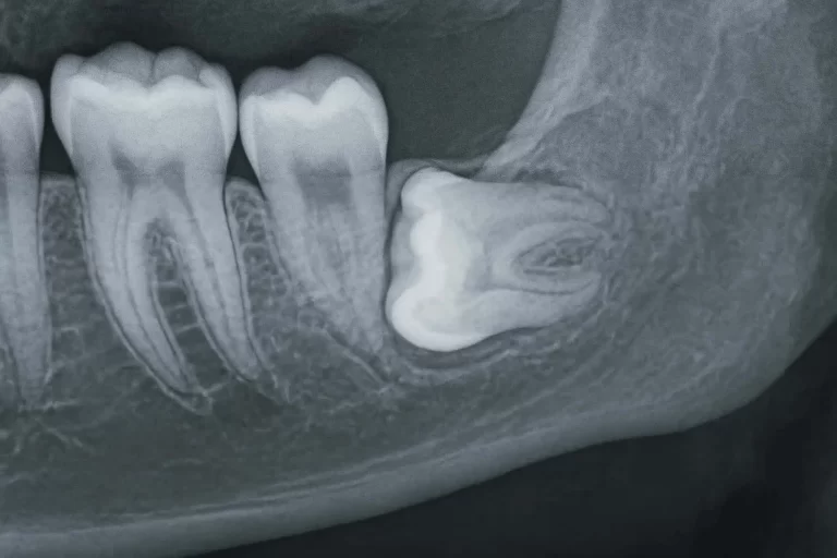 Wisdom Teeth & Dental Extractions