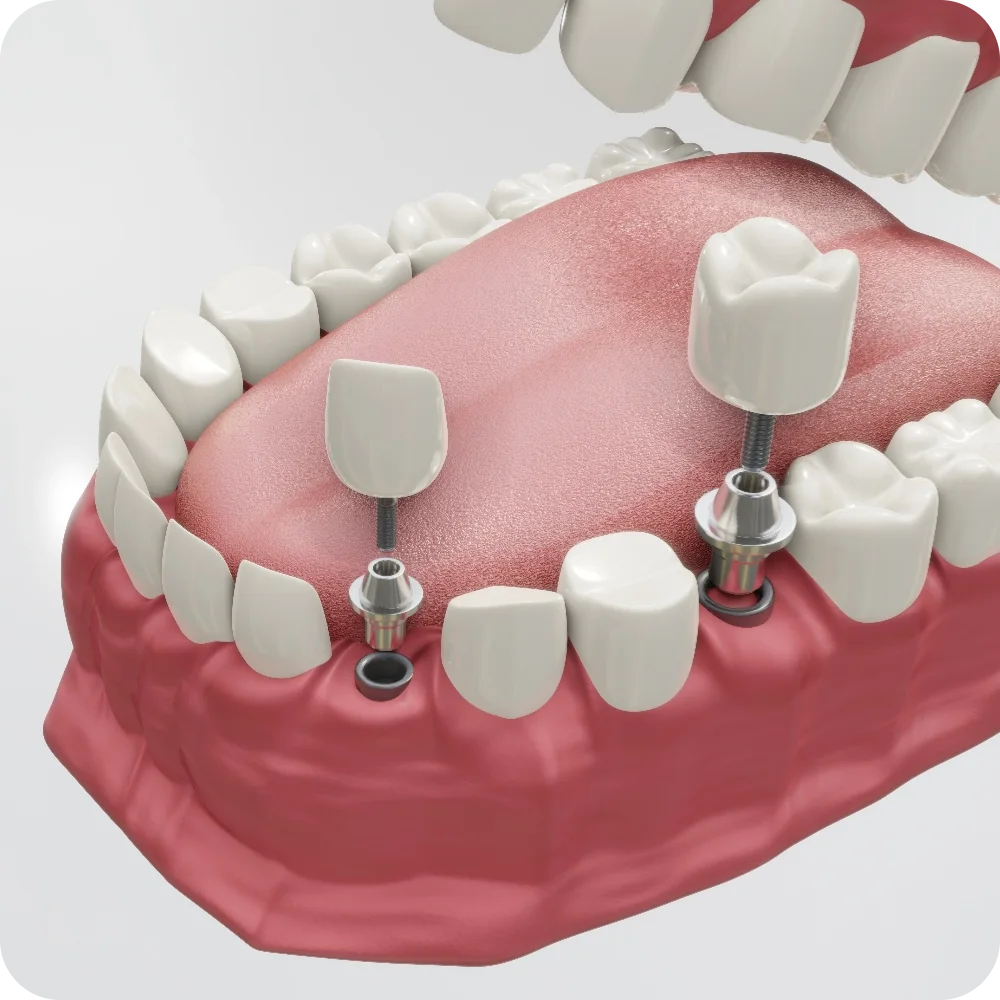 Single Tooth Replacement Img