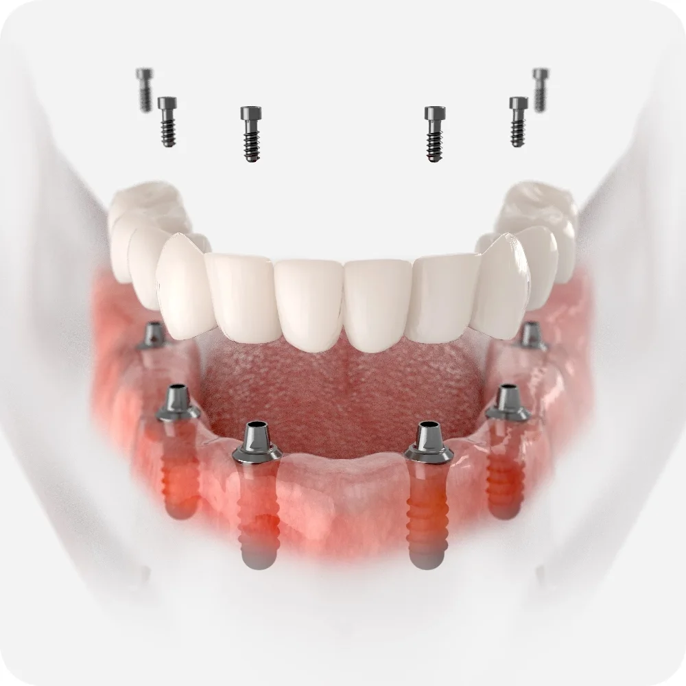 Full Arch Implant Treatment Img