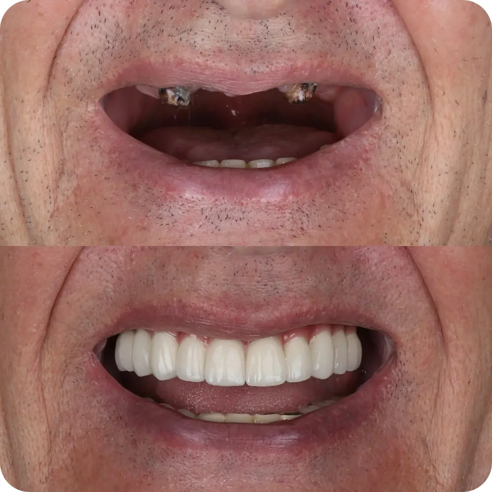Missing Teeth Img 2