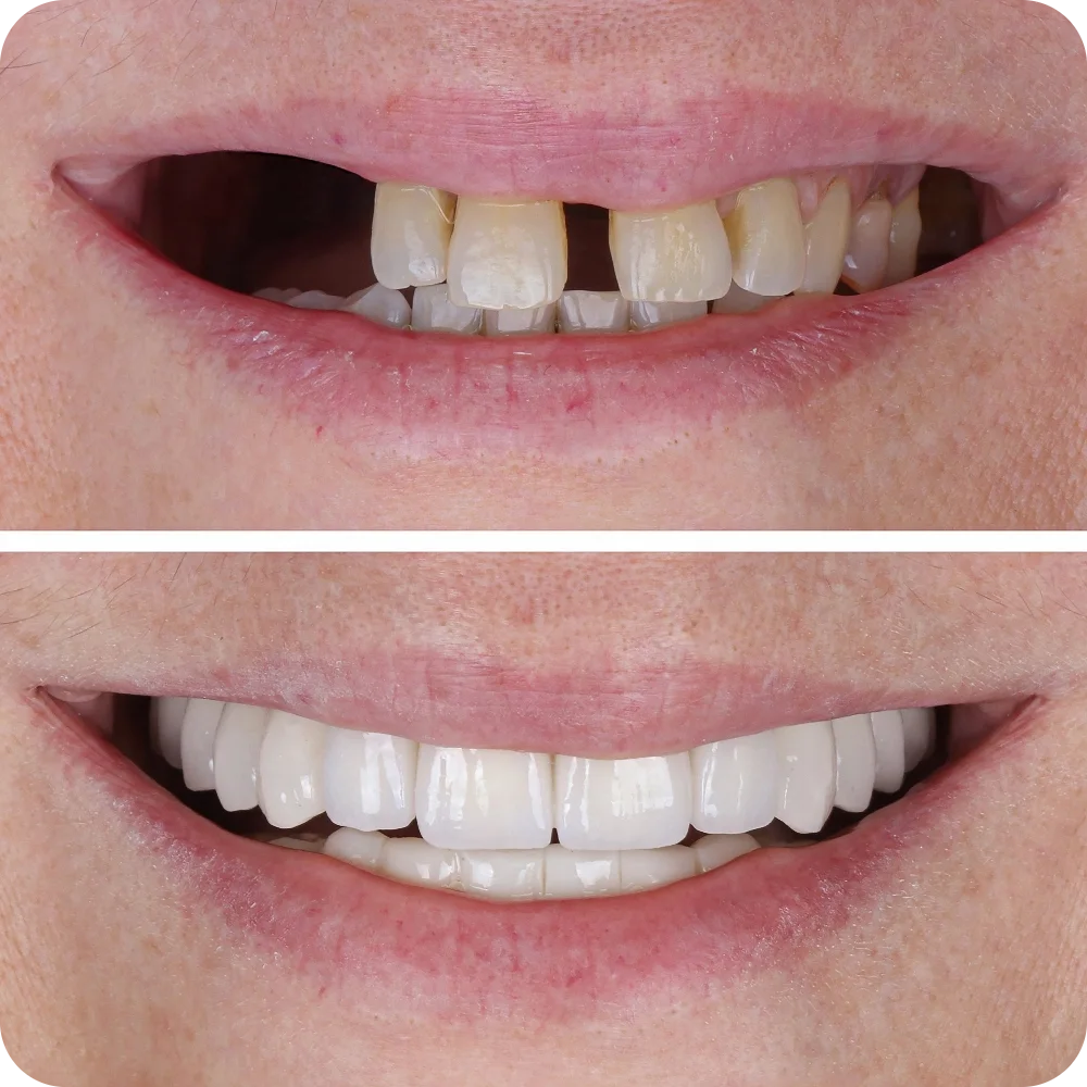 Missing Teeth Img