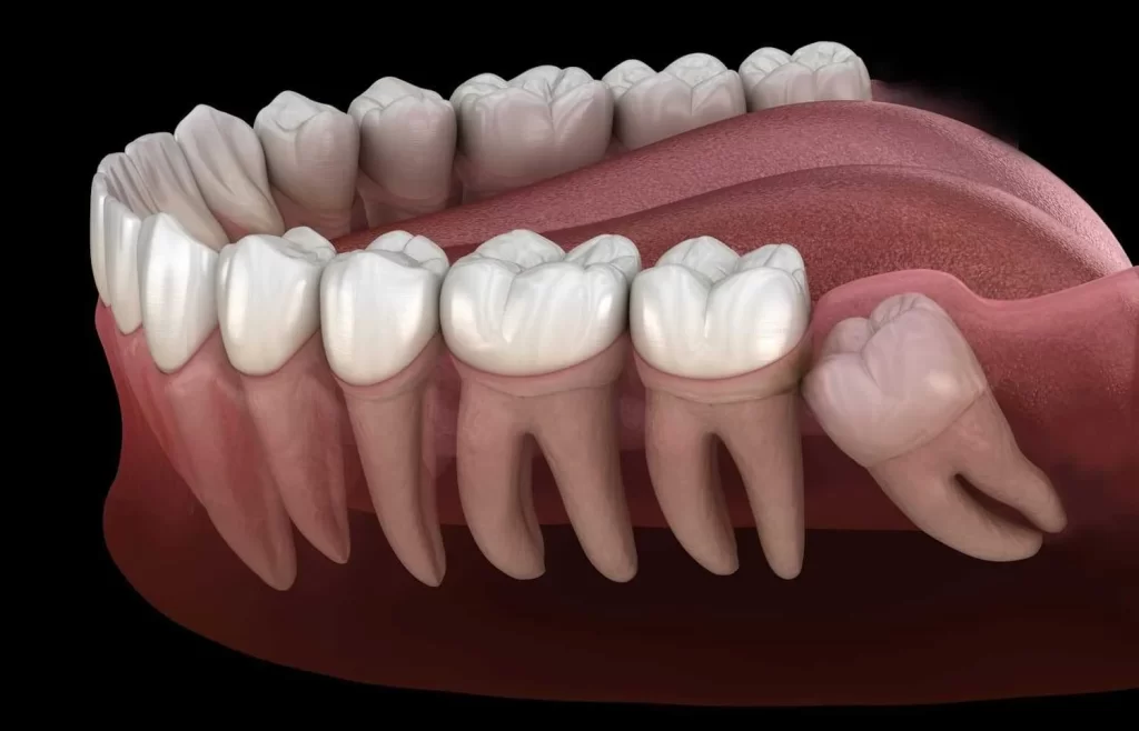 Wisdom Teeth Img